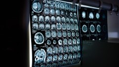 Zastosowanie sztucznej inteligencji w medycynie. Jakie są korzyści dla…